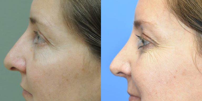 Before & After Photo of a Des Moines Plastic Surgery patient who received Nose Surgery treatment