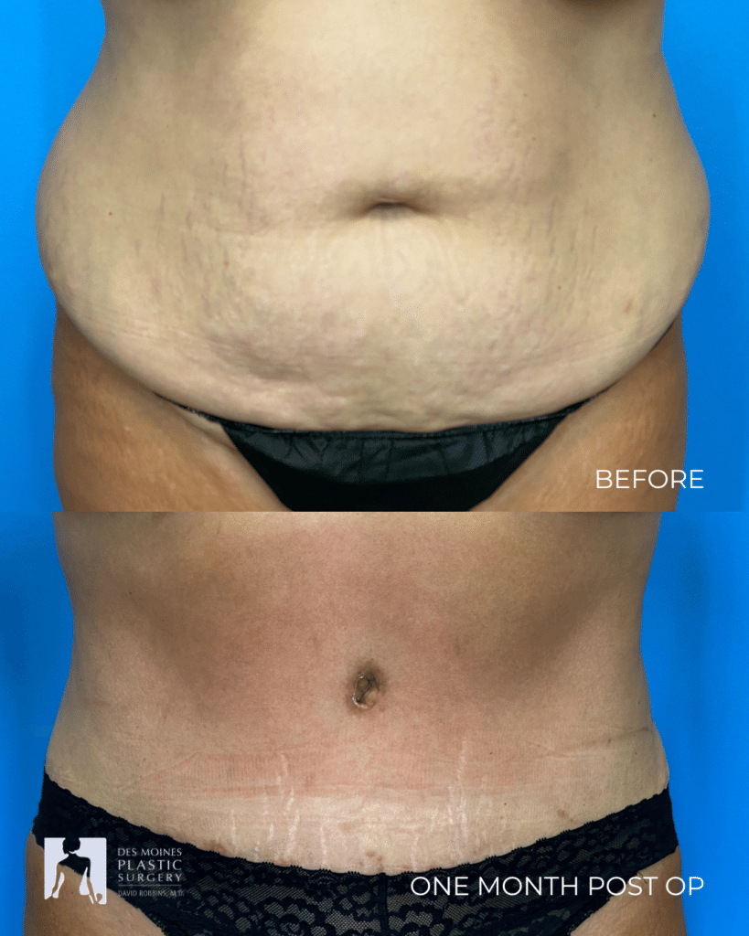 abdominoplasty ()