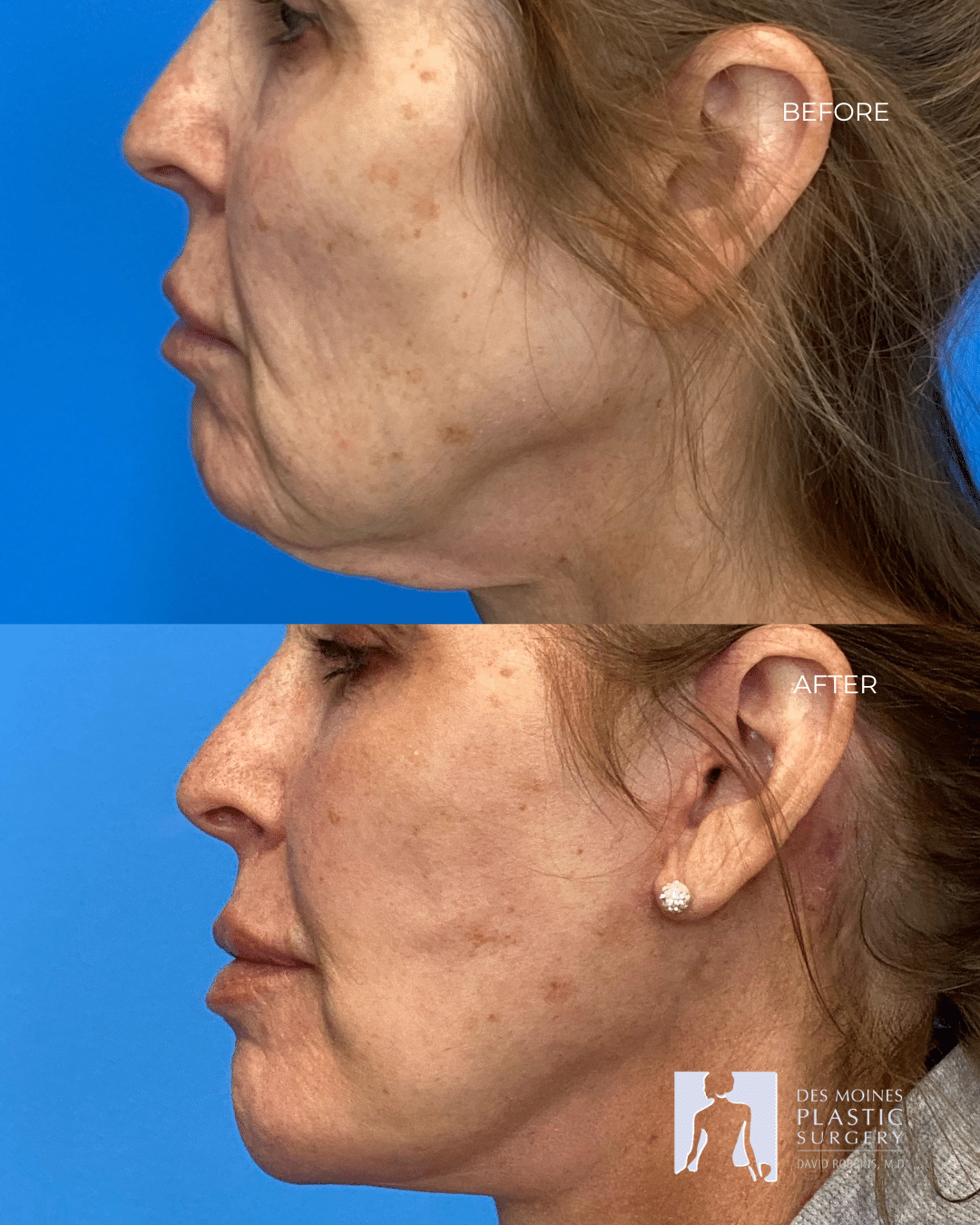 s lift before and after