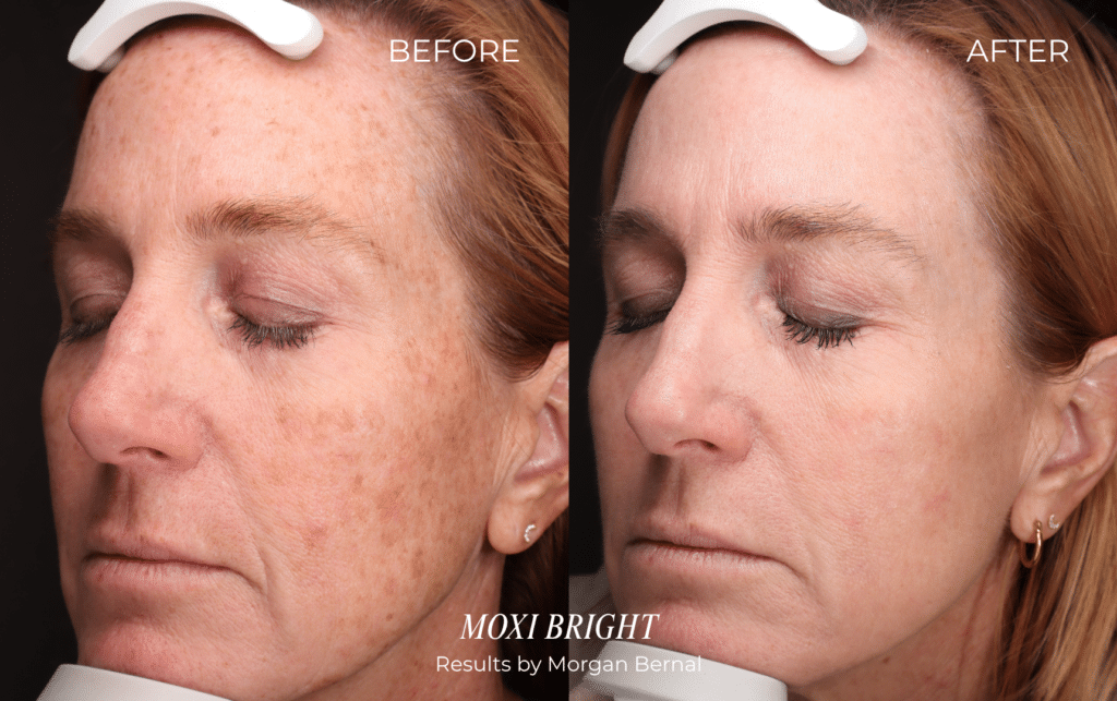 MOXI BRIGHT before and after